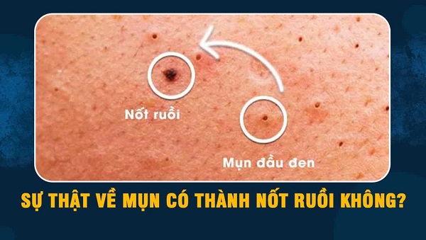 mụn đầu đen để lâu có thành nốt ruồi không