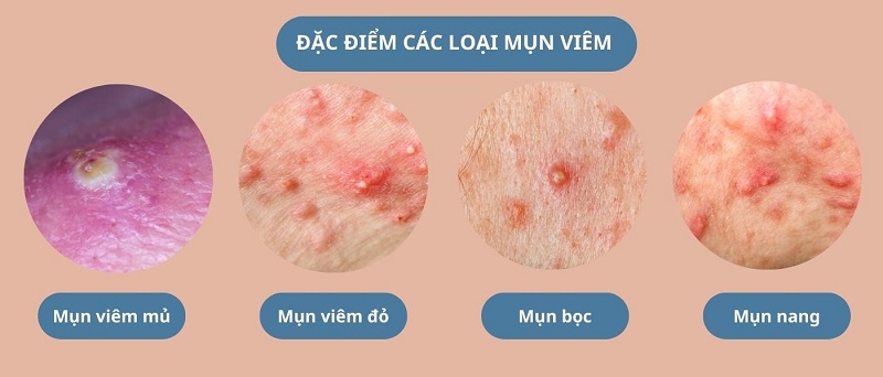 Các loại mụn viêm