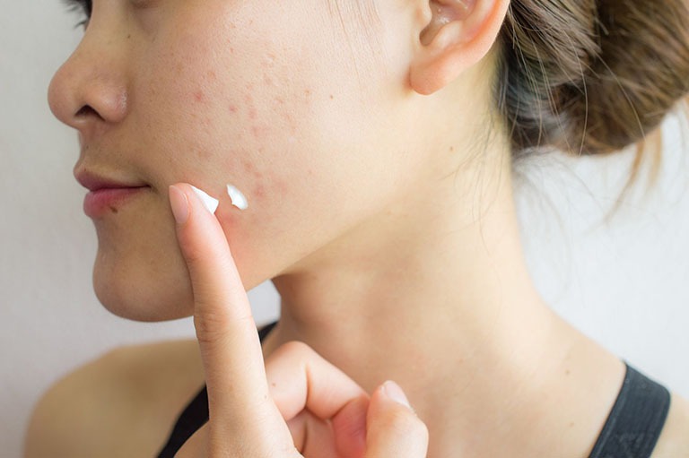 Tretinoin có trị mụn viêm không? Câu trả lời từ chuyên gia da liễu