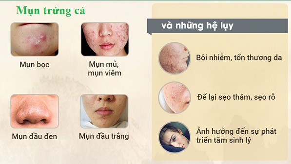 Các loại mụn trứng cá